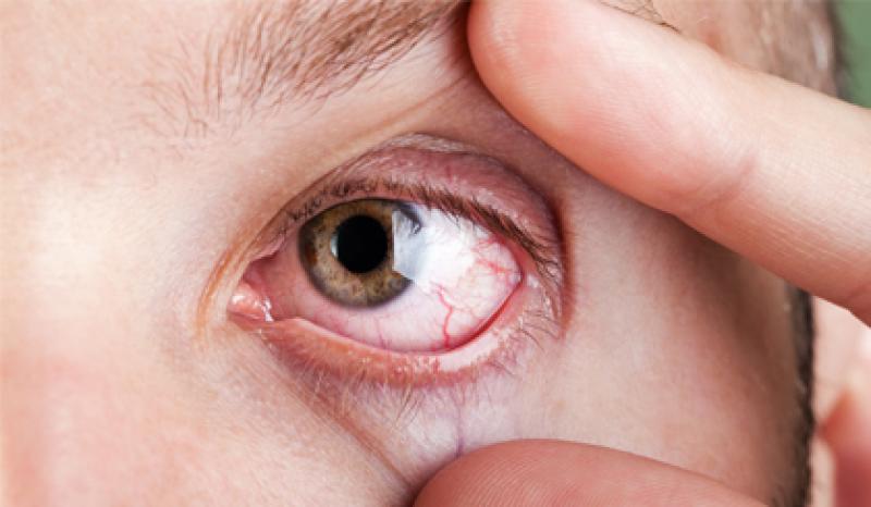 Capa de post: Toxoplasmose Ocular